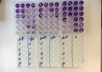 Türk doktor, meme kanserine çare olacak ilacı buldu