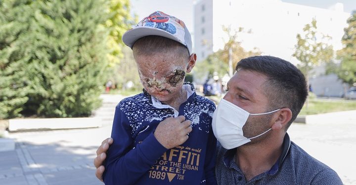 Cilt kanseri Salih’in tedavisi başladı