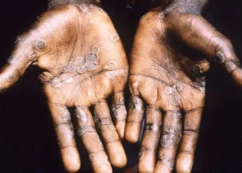 Maymun çiçeği virüsü 4 ülkeye daha sıçradı