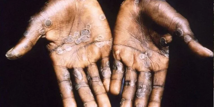 Maymun çiçeği virüsü 4 ülkeye daha sıçradı