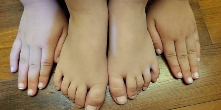 Covid-19 olan çocuğun tırnakları beyazladı