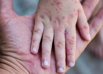 Sağlık Bakanlığı’ndan ‘maymun çiçeği’ rehberi