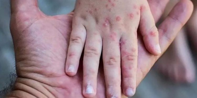 Sağlık Bakanlığı’ndan ‘maymun çiçeği’ rehberi