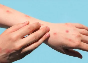 DSÖ maymun çiçeğinde Türk hastayı örnek gösterdi