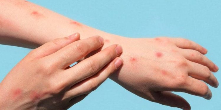 DSÖ maymun çiçeğinde Türk hastayı örnek gösterdi