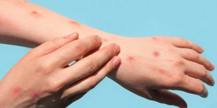 DSÖ maymun çiçeğinde Türk hastayı örnek gösterdi