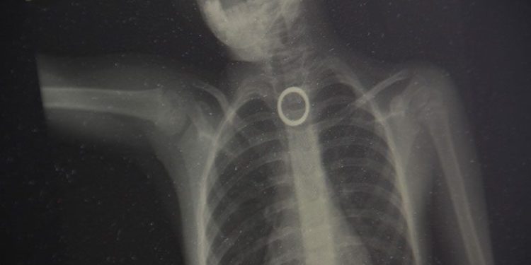 Yüzük yutan çocuk ölümden döndü