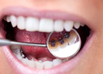 ‘’Ortodontik tedaviler çürüğe neden olmaz’’