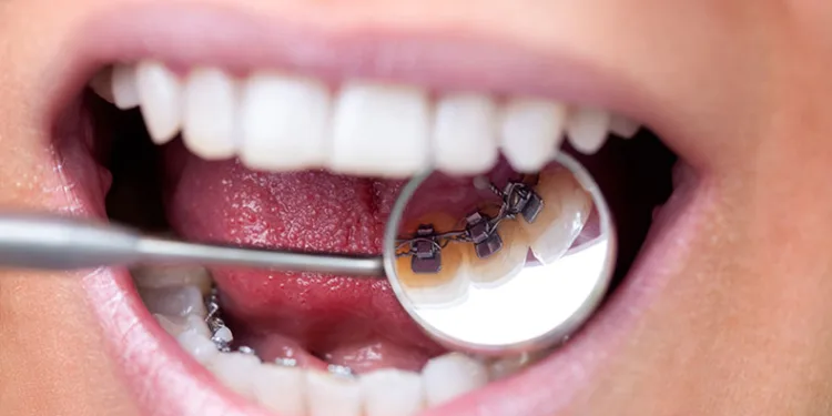 ‘’Ortodontik tedaviler çürüğe neden olmaz’’