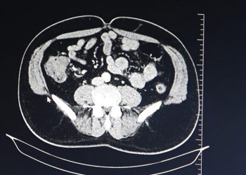 Kolon kanserine karşı uyarı