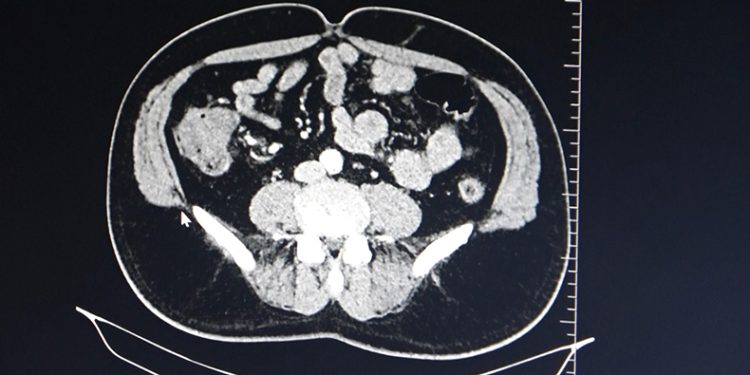 Kolon kanserine karşı uyarı