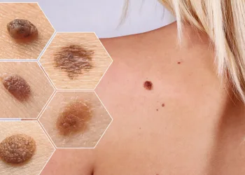 Güneş ışınları cilt kanserine yol açabilir