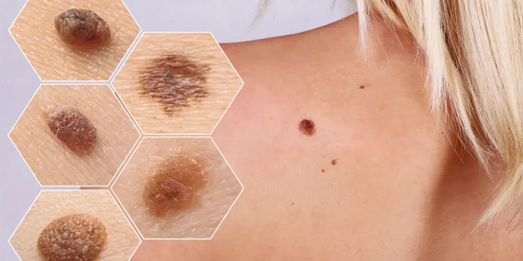 Güneş ışınları cilt kanserine yol açabilir