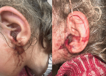 Küçük çocuğun kulağından onlarca kurtçuk çıkartıldı