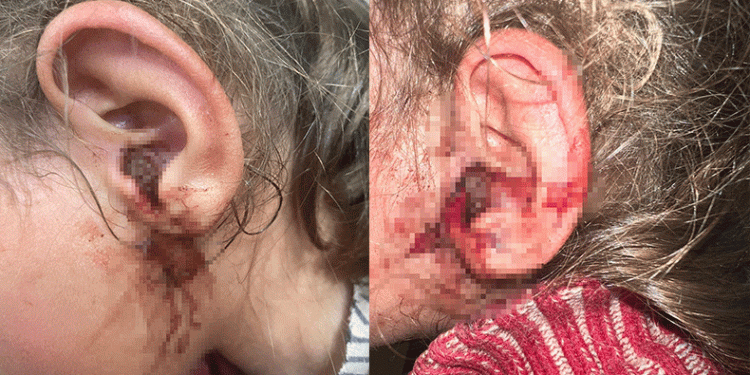 Küçük çocuğun kulağından onlarca kurtçuk çıkartıldı