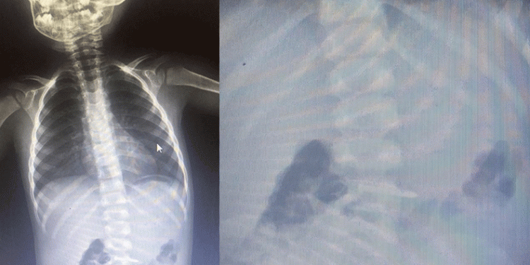 Bursa’da 2 yaşındaki çocuk çivi yuttu