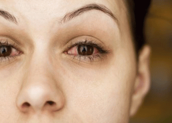 Pakistan’da kırmızı göz salgını