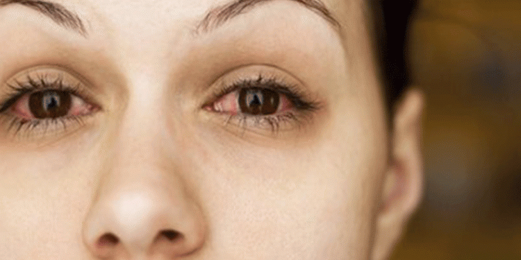 Pakistan’da kırmızı göz salgını