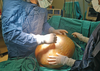 Karpuz büyüklüğündeki tümör göğsünü patlattı