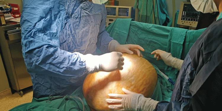 Karpuz büyüklüğündeki tümör göğsünü patlattı