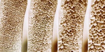 ‘Kemik erimesi ölüme yol açabilir’