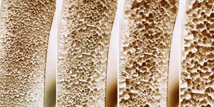 ‘Kemik erimesi ölüme yol açabilir’