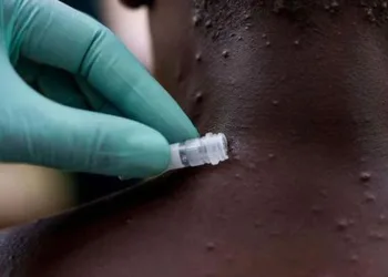 Maymun çiçeği virüsü İsveç’e sıçradı