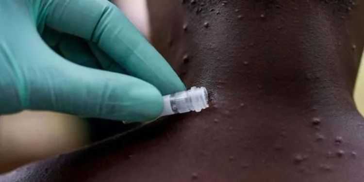 Maymun çiçeği virüsü İsveç’e sıçradı