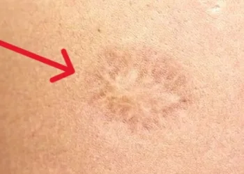 1980 öncesi çiçek aşısı olanlar şanslı