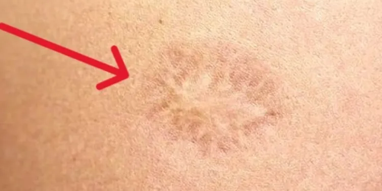 1980 öncesi çiçek aşısı olanlar şanslı