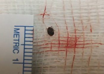 Hastanın gözünde canlı kene çıktı