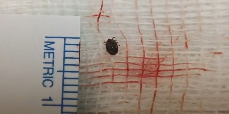 Hastanın gözünde canlı kene çıktı