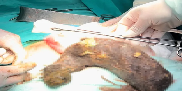 Genç kızın karnından 2 kilogram kıl yumağı çıktı