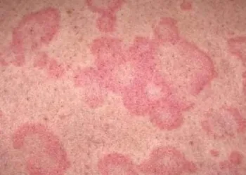 Uzmanı uyardı: Sıcak hava cilt kanserine neden oluyor