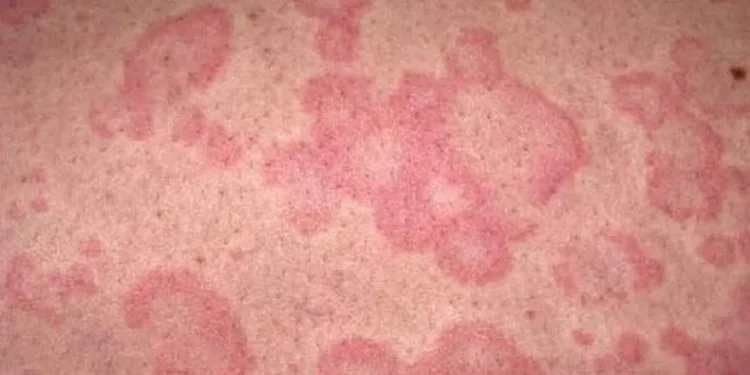 Uzmanı uyardı: Sıcak hava cilt kanserine neden oluyor