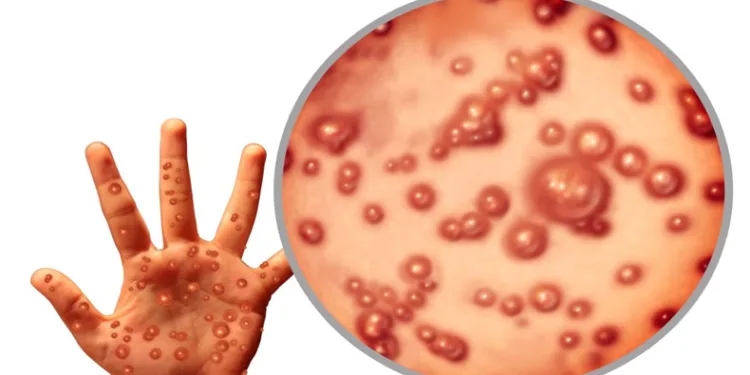 “Maymun çiçeği virüsünden ölüm oranı yüzde 3-6”