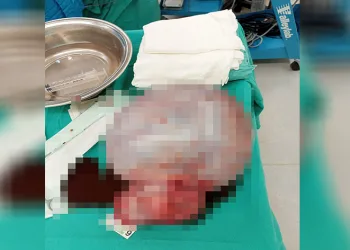 Antalya’da İngiliz hastanın karnından 6 kilogram kitle çıkarıldı