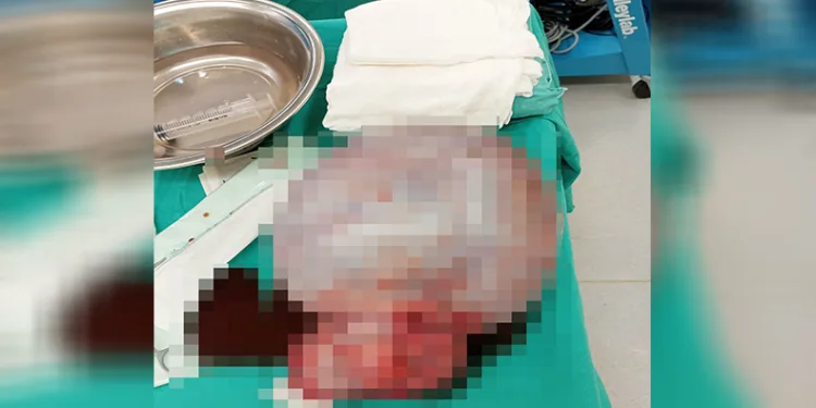 Antalya’da İngiliz hastanın karnından 6 kilogram kitle çıkarıldı