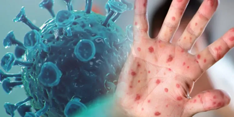 Sağlık Bakanlığı ‘maymun çiçeği rehberi’ yayımladı